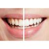 Spin Smile 360 Professional Grade Tooth Polisher-2248-01