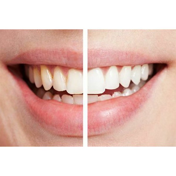 Spin Smile 360 Professional Grade Tooth Polisher-2248